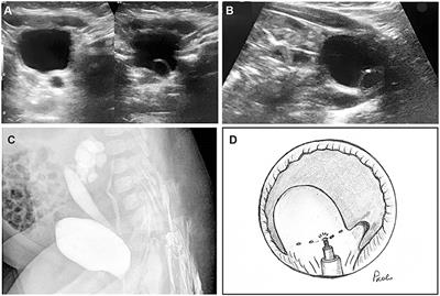 Minimally Invasive Laser Treatment of Ureterocele